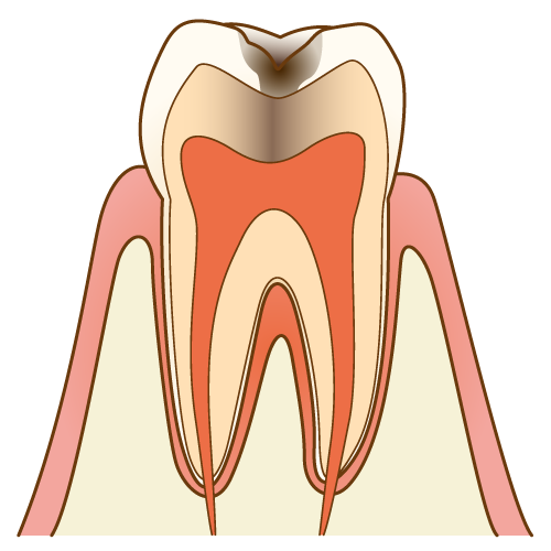 虫歯治療3