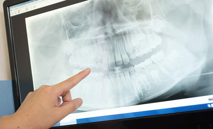 歯科用CTを治療に使用する必要性