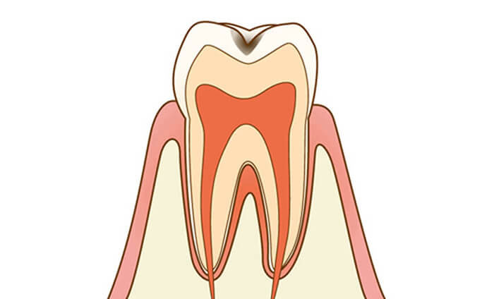 虫歯治療のイメージ