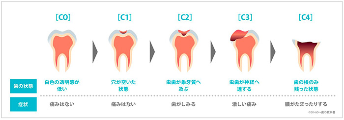 虫歯治療のイメージ