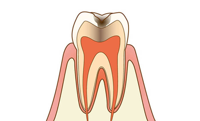 虫歯治療のイメージ