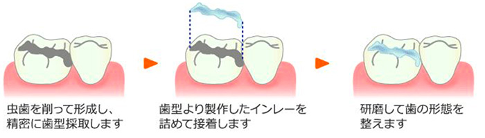 虫歯治療のイメージ