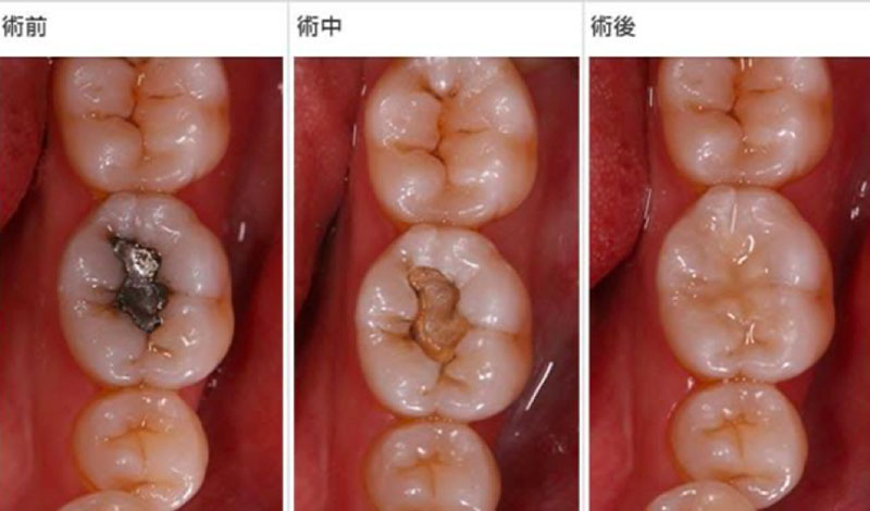 虫歯治療のイメージ