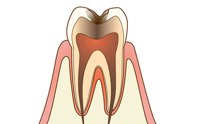 虫歯治療のイメージ