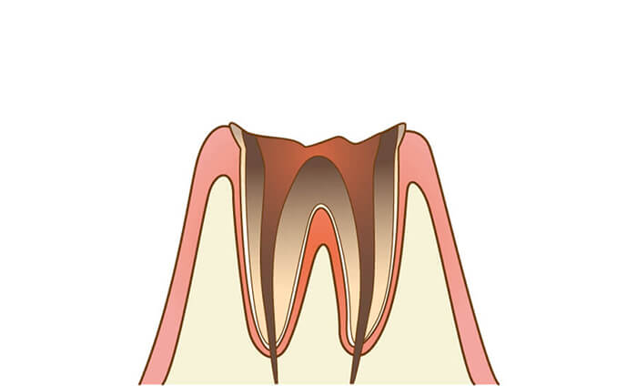 虫歯治療のイメージ