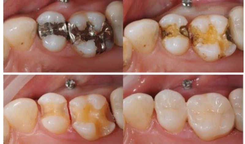 虫歯治療のイメージ