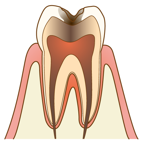 虫歯治療4