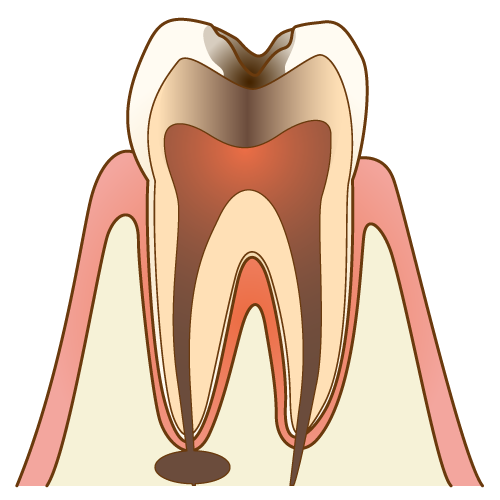 虫歯治療5