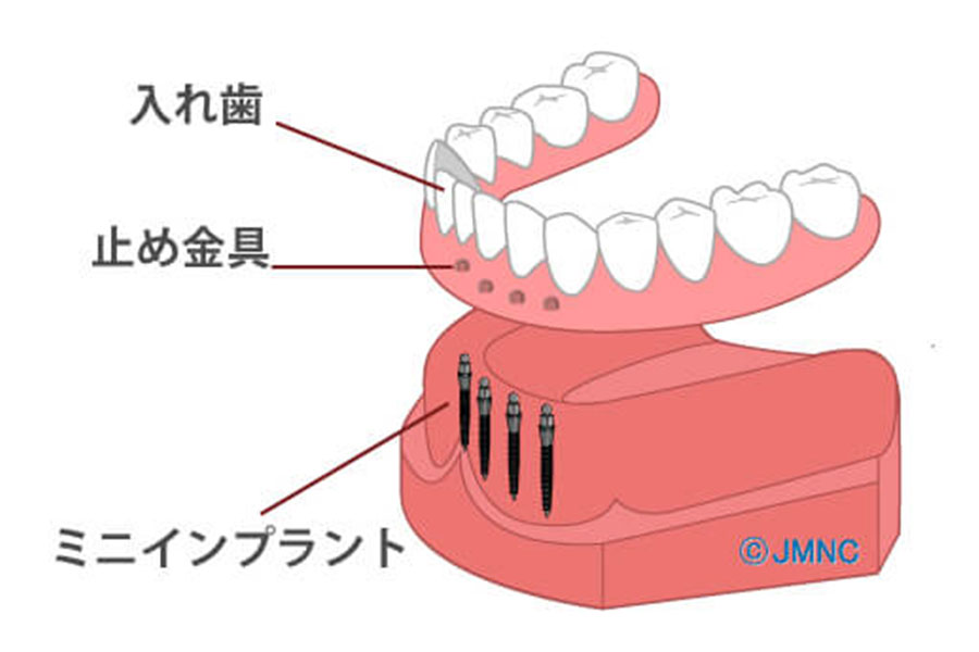 抜歯が必要になる原因とは？