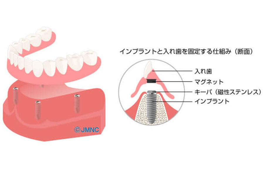 抜歯が必要になる原因とは？