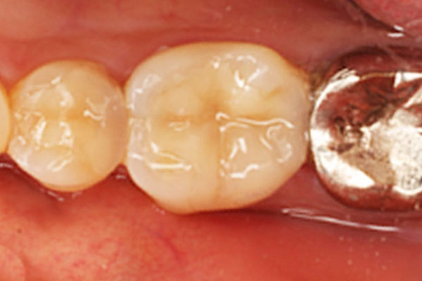 審美歯科のイメージ