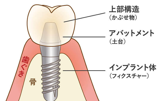 セラミック