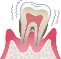 歯周炎