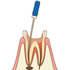 根管治療