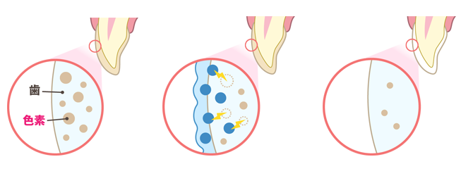 歯を削ったり、溶かしたりしないですか？