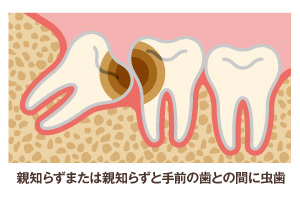 ②虫歯