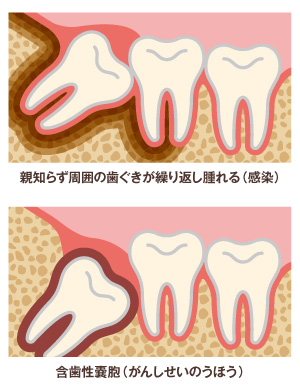 ①智歯周囲炎