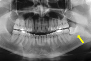 親知らずの抜歯方法