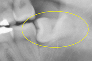 親知らずの抜歯方法