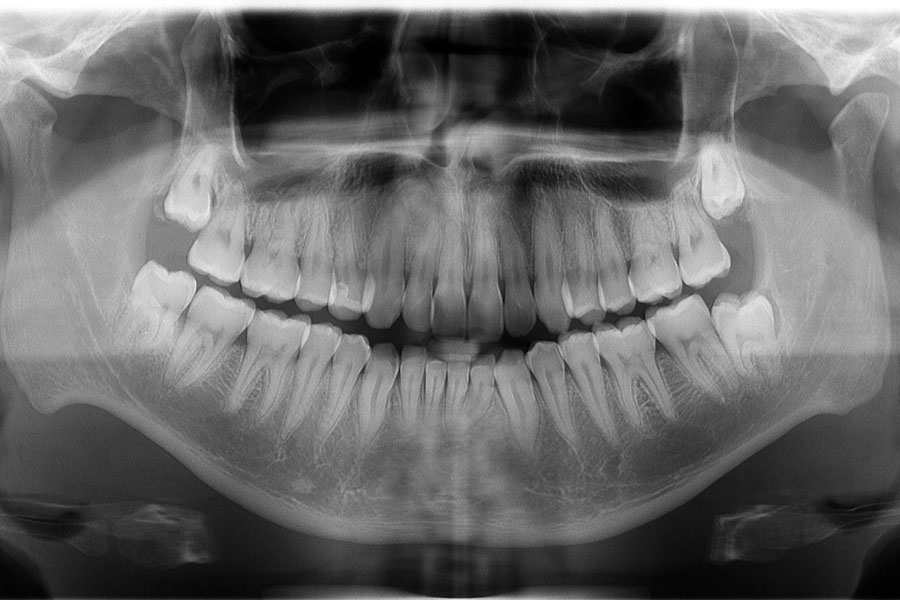 親知らずの抜歯に必要なレントゲン撮影とCT